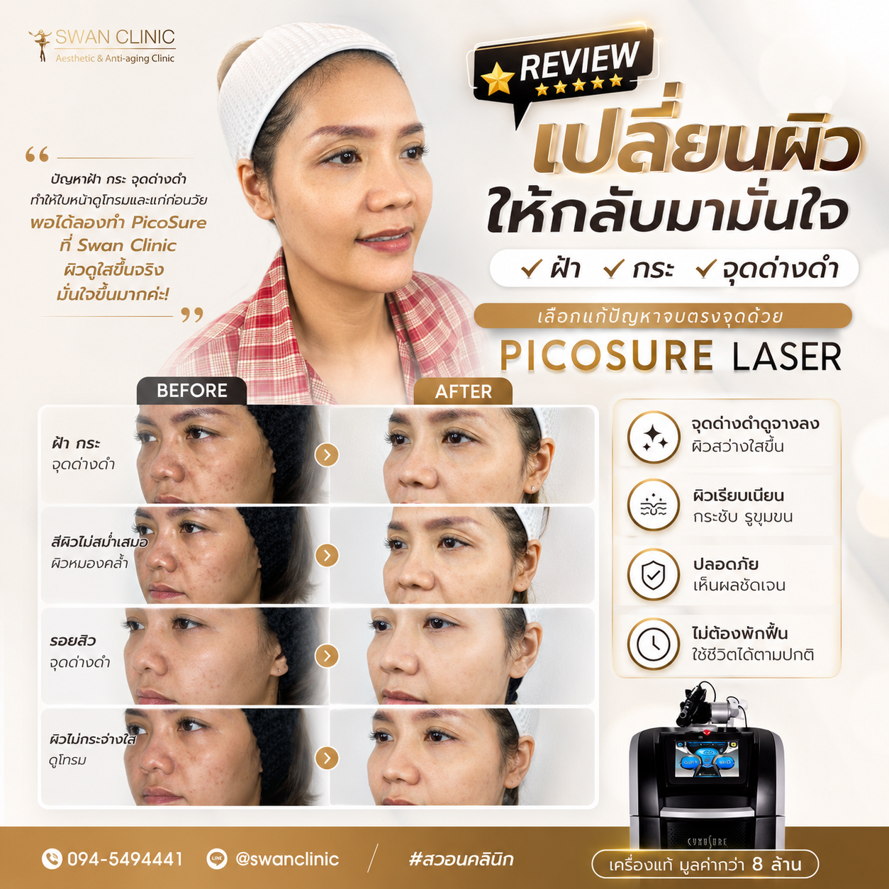 รีวิว PicoSure Laser Before After ฝ้า กระ จุดด่างดำ