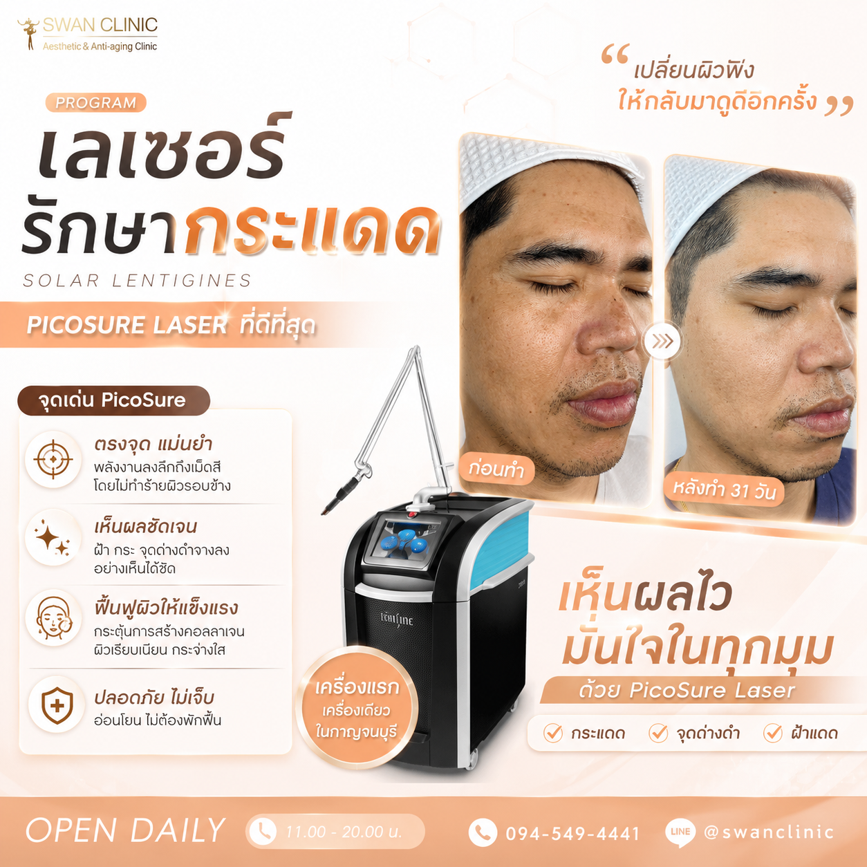 PicoSure Laser รักษากระแดด Solar Lentigines เห็นผลใน 31 วัน