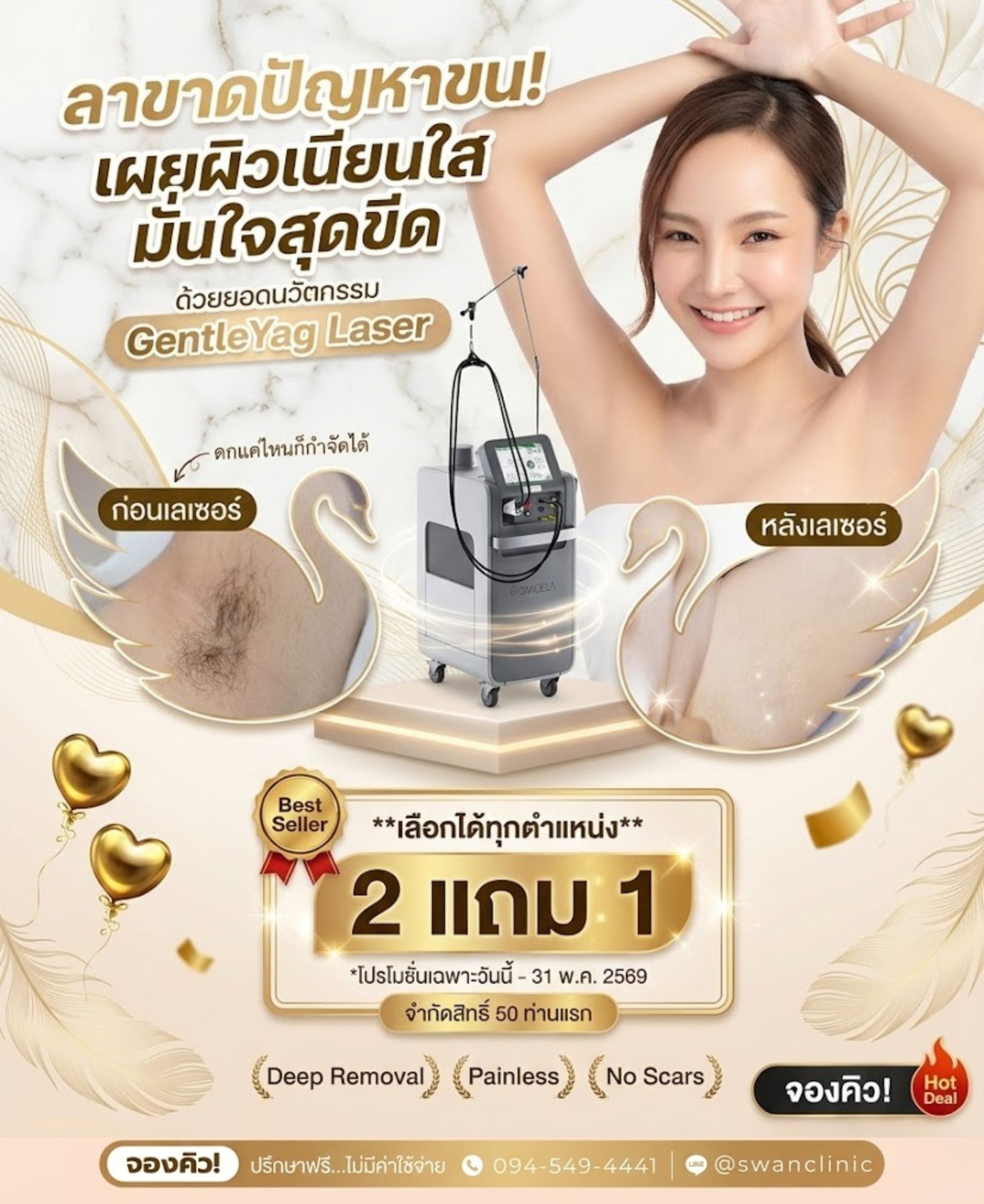 GentleYag Laser 2 แถม 1